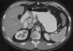 Normal Post Whipple Pancreas - CTisus CT Scan