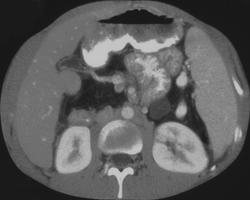 Cystic Fibrosis With Dilated Bowel - CTisus CT Scan