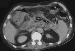 Pancreatic Abscess - CTisus CT Scan