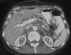 Pancreatic Cancer - CTisus CT Scan