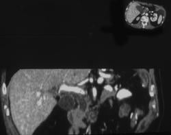 Stone in Distal Common Bile Duct - CTisus CT Scan