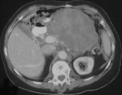 Cystadenoma Pancreas - CTisus CT Scan