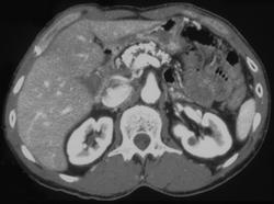 Chronic Pancreatitis - CTisus CT Scan