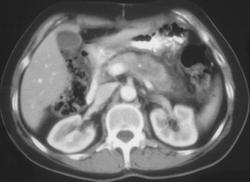 Pancreatic Cancer Invades Splenic Vein - CTisus CT Scan