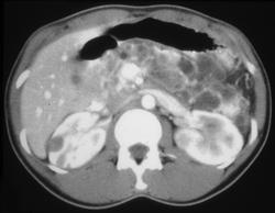 Von Hippel-Lindau syndrome (VHL) With Multiple Renal Carcinomas With Metastases to the Pancreas - CTisus CT Scan