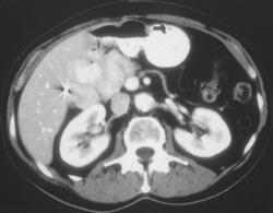 Normal Post Whipple Study - CTisus CT Scan