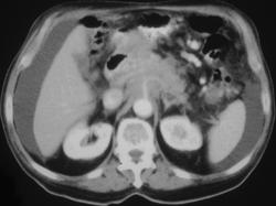 Pancreatic Cancer With Vessel Encasement - CTisus CT Scan