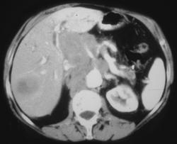 Pancreatic Cancer With Vessel Encasement and Liver Metastases - CTisus CT Scan