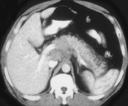 Lymphoma Infiltrates the Pancreas - CTisus CT Scan