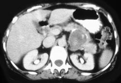 Splenic Artery Aneurysm Simulates A Pancreatic Mass - CTisus CT Scan