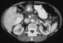 Invasive Pancreatic Cancer Recurrence - CTisus CT Scan