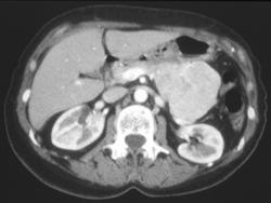 Islet Cell Tumor of the Pancreas - CTisus CT Scan