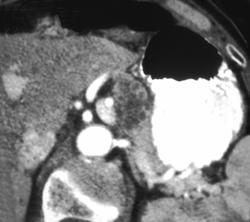 Cystadenoma of the Pancreas - CTisus CT Scan