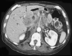 Invasive Pancreatic Adenocarcinoma - CTisus CT Scan