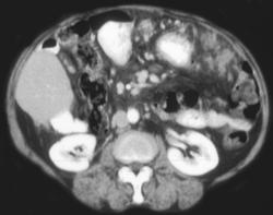 Carcinomatosis With Implants - CTisus CT Scan