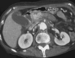 Pancreatic Cancer Presents as An Abdominal Aortic Aneurysm - CTisus CT Scan