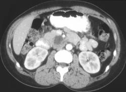 Serous Cystadenoma - CTisus CT Scan