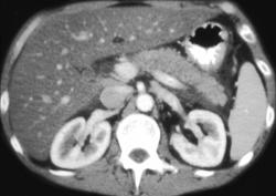 Acute Pancreatitis - CTisus CT Scan