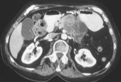 Adenocarcinoma of the Tail of the Pancreas - CTisus CT Scan