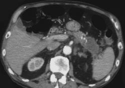 Pancreatic Cancer Invades the Splenic Vein - CTisus CT Scan