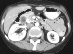 Mucinous Carcinoma of the Pancreas - CTisus CT Scan