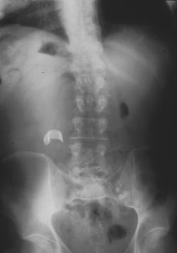 Retained Sponge Simulates A Pancreatic Pseudocyst - CTisus CT Scan