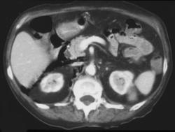 Duodenal Perforation With Free Air S/P An ERCP - CTisus CT Scan