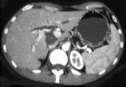 Lymphoma Infiltrares the Pancreas - CTisus CT Scan