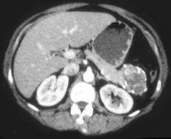 Cystadenoma of the Tail of the Pancreas - CTisus CT Scan