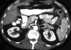 Annular Pancreas - CTisus CT Scan