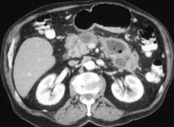 Pancreatic Abscess - CTisus CT Scan