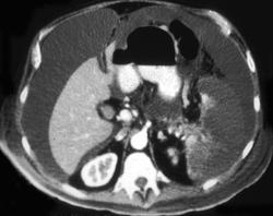 Carcinoma of the Pancreas Invades Splenic Artery & Vein & Results in Splenic Infarction - CTisus CT Scan