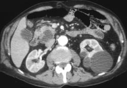 Cystadenoma of the Pancreas - CTisus CT Scan