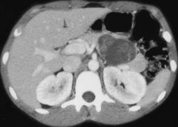 Hamoudi Tumor - CTisus CT Scan