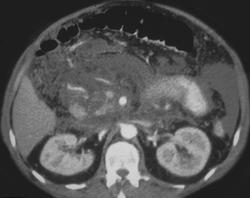 Acute Pancreatitis - CTisus CT Scan