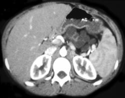 Cystic Fibrosis Involves the Pancreas - CTisus CT Scan