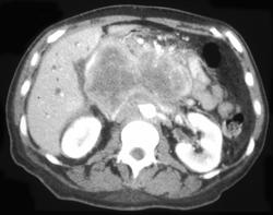 Large Cell Carcinoima of the Pancreas - CTisus CT Scan