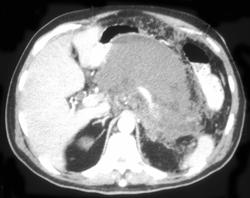 Pancreatitis - CTisus CT Scan