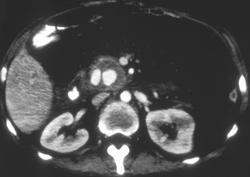 Pseudoaneurysm of the Gastrointestinal Artery - CTisus CT Scan