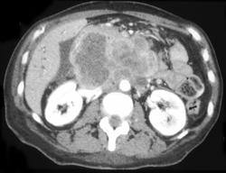 Anaplastic Carcinoma of the Pancreas - CTisus CT Scan