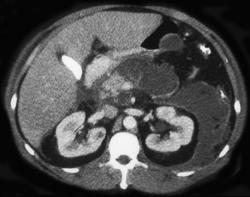 Acute Pancreatitis S/P ERCP - CTisus CT Scan