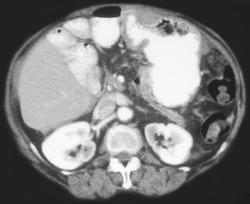 Carcinomatosis S/P Whipple Procedure - CTisus CT Scan