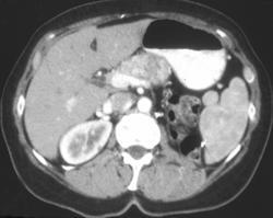 Renal Cell Carcinoma Metastatic to the Pancreas - CTisus CT Scan