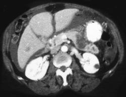 Carcinoma of the Pancreas With Carcinomatosis - CTisus CT Scan