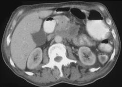 Invasive Pancreatic Cancer - CTisus CT Scan