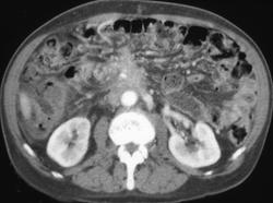 Recurrent Carcinoma of the Pancreas With Vascular Invasion - CTisus CT Scan