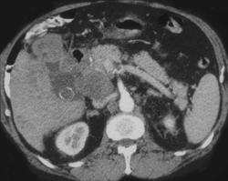 Neuroendocrine Tumor of the Pancreas - CTisus CT Scan