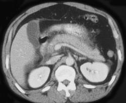 Acute Pancreatitis - CTisus CT Scan