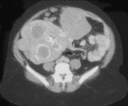 Uterine Fibroids Simulate A Pancreatic Mass - CTisus CT Scan