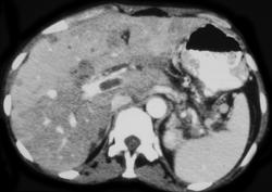 Portal Vein Thrombosis Due to Carcinoma of the Pancreas - CTisus CT Scan